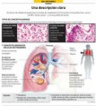 /album/fotogaleria/cancer-de-pulmon-jpg/